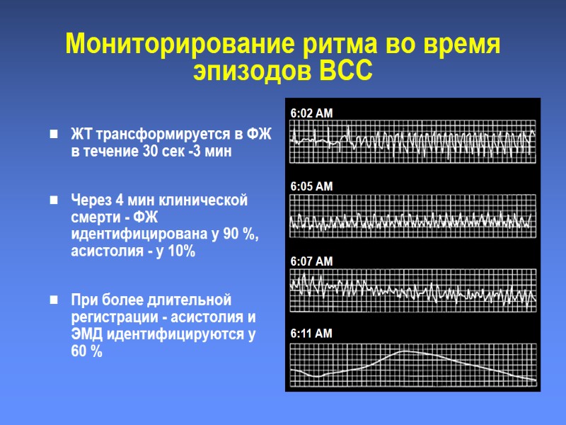 Мониторирование ритма во время эпизодов ВСС 6:02 AM 6:05 AM 6:07 AM 6:11 AM